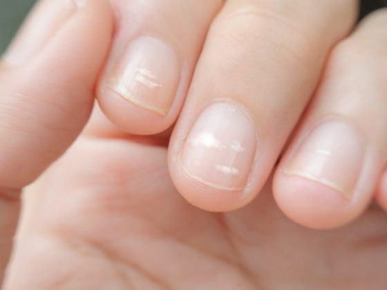 Значение белых пятен на ногтях